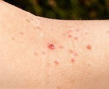 Image result for Wart On My Arm