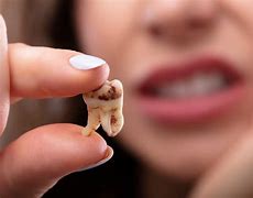 Image result for Bad Molar Teeth