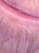 Image result for Eyelid Margin Cyst