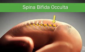 Image result for Occult Spina Bifida