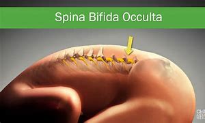 Image result for Mild Spina Bifida Occulta