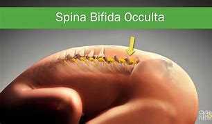 Image result for Spina Bifida Occulta