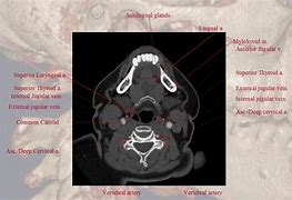 Image result for Common Carotid Artery CT