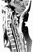 Image result for Meningioma Cervical Spine Tumor