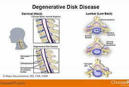 Image result for Degenerative Disc Disease Thoracic Spine
