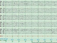 Image result for Wicket Spikes EEG