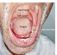 Image result for Oral Cancer On Gums