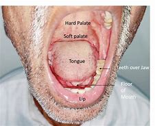 Image result for Oral HPV Under Tongue