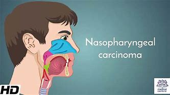 Image result for Nasal Polyps Cancer Symptoms