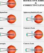 Image result for Refractive Corrective Lens
