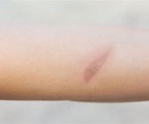 Image result for Minor Skin Burn