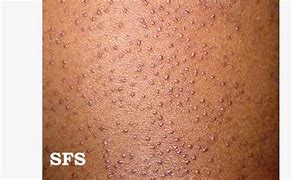 Image result for Keratosis Pilaris On Dark Skin
