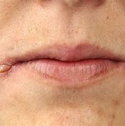 Image result for Iron Deficiency Rash around Mouth