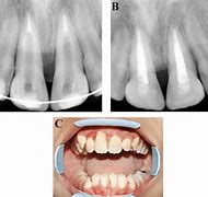 Image result for Rotated Central Incisors