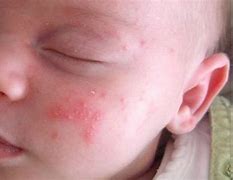 Image result for Baby Eczema Rash On Face