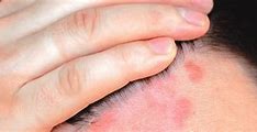 Image result for Eczema Forehead