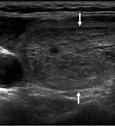 Image result for Spongiform Nodule Ultrasound