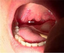 Image result for Lata Condyloma Lesions