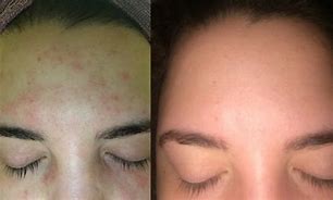 Image result for Allergic Reaction to Shampoo On Face