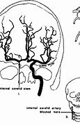 Image result for Cranial Bruit