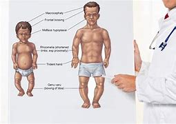 Image result for aconcroplasia