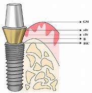 Image result for Biological Implants