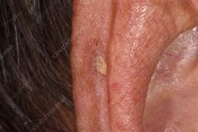 Image result for Squamous Papilloma Ear