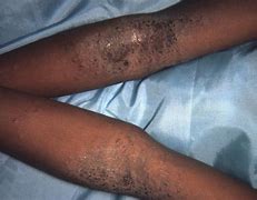 Image result for Eczema Black People