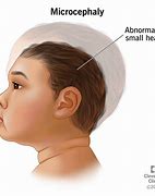Image result for Microcephaly Head
