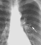 Image result for Carcinoid Tumor Bronchoscopy