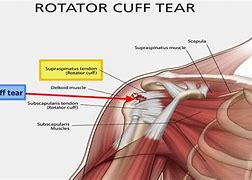 Image result for Torn Rotator Cuff Left Shoulder
