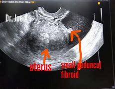 Image result for What Is a Fibroid Cyst in the Uterus
