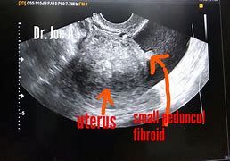 Image result for 10 Cm Fibroid