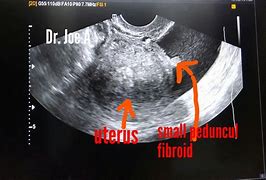 Image result for 8 Cm Uterine Fibroid
