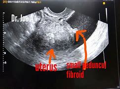 Image result for Uterine Fibroid Cysts