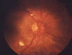 Image result for Cotton-Wool Spots Retina in Anemia
