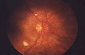 Image result for Yellow Spot On Retina