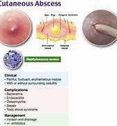 Image result for Abscess Popping