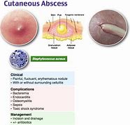 Image result for Types of Abscess