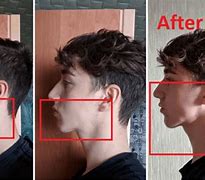 Image result for Mewing Forward Face