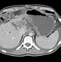 Image result for Pancreatic Cancer CT Scan