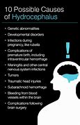 Image result for Hydrocephalus Signs and Symptoms Baby