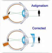 Image result for Astigmatism Severity Scale