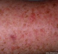 Image result for Epidermolysis Verruciformis