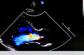 Image result for cardiogrwf�a