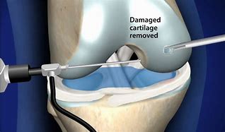 Image result for Arthroscopic Hip Surgery Recovery