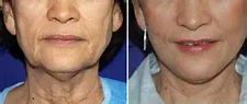 Image result for Rhytidectomy Before and After