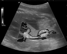 Image result for Umbilical Cord Artery and Vein