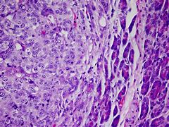 Image result for Histology of Acral Melanoma