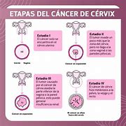Image result for Cervical Cancer Metastasis